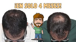 🔴¡¡RECUPERÓ SU PELO EN SOLO 4 MESES😱 [upl. by Adela]