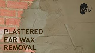 Plastered Ear Wax Removed off Eardrum  378 [upl. by Burnett382]