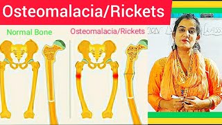 Osteomalacia amp Rickets  Cause Symptom Treatment Diagnosis MedicalSurgical amp Nursing Management [upl. by Georges]