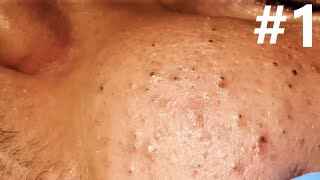 BIG BLACKHEADS EXTRACTIONS on Happy   1 [upl. by Patman289]