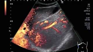 Ultrasound Video showing Hepatic parenchymal disease in a young patient of about 23 years [upl. by Carrington553]