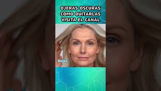 Ojeras Bótox Como Quitarlas 4 [upl. by Isobel]