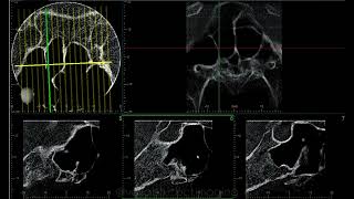 SPHENOID SINUS CASE REPORT [upl. by Mirabel]