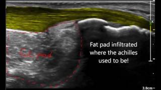 Haglund deformity versus haglund syndrome [upl. by Yllime]