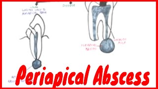 Periapical Abscess Causes Symptoms amp Treatment [upl. by Irallih]