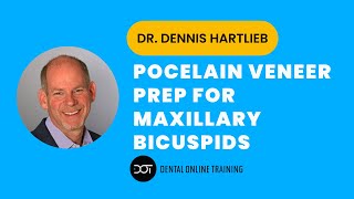 Porcelain Veneer Preparation for Maxillary Bicuspids  Prepless Technique  Dental Online Training [upl. by Ehcram539]