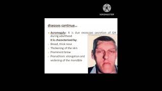 Acromegaly physiotherapy physiology youtube shorts [upl. by Nayr]