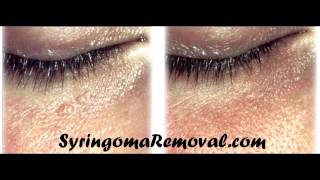 Syringoma removal cryotherapy [upl. by Eardna]