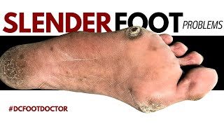 Slender Foot Problems Removing Painful Calluses [upl. by Ezekiel346]