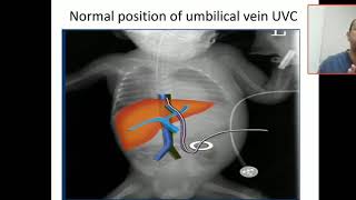 Case study 9 umblical venous catheter position and malposition [upl. by Senilec]