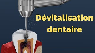 ⭕ Devitalisation dent ou Étape dEndodontie  carie dentaire [upl. by Eerhs747]