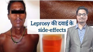 Leprosy की दवाइयों के sideeffects  Dapsone  Clofazimine  Rifampicin  Hansens disease leprosy [upl. by Alcott]