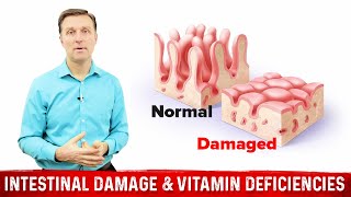 Intestinal Obstruction amp Vitamin Deficiencies – Dr Berg [upl. by Fernald]