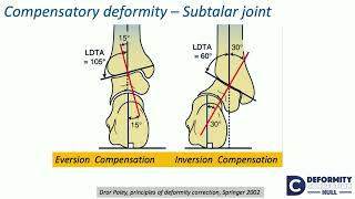 Compensatory theory of osteotomies around kneeEffect on Hip amp FampA alternate ways  H Sharma [upl. by Derwood]