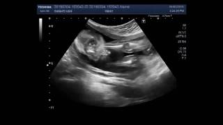 Ultrasound Video showing Club foot fetal anomaly scan [upl. by Thinia]