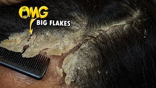 Dandruff Removal Big Flakes Satisfying 811 [upl. by Supmart204]