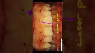 Laser gingivectomy [upl. by Yaras]