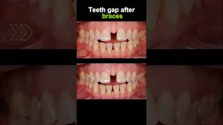 Teeth gap after braces braces orthodontist dentist niengrang [upl. by Faucher]