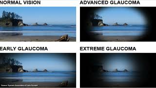 Glaucoma  An Introduction for Patients [upl. by Auqenes302]