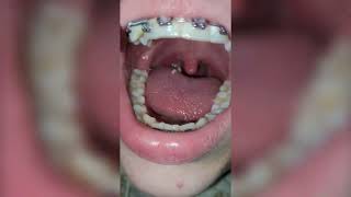 Deep Tonsil Stone Removal  Tonsil Stones [upl. by Housen488]