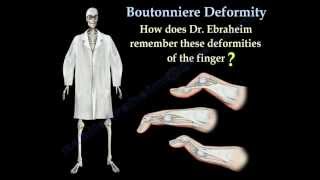 Boutonniere Deformity  Everything You Need To Know  Dr Nabil Ebraheim [upl. by Lannie308]