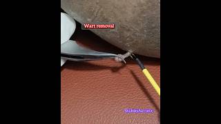 Wart removal treatment Shubiksha hair and skin care clinic balaji Nagar katturtrichy9150923153 [upl. by Adikam]