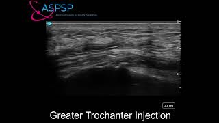 Ultrasound Guided Greater Trochanteric Bursa Injection [upl. by Ahsile]