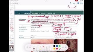 Scar Formation  hypertrophic vs keloid  Pathology 34  First Aid USMLE Step 1 in UrduHindi [upl. by Cinimod]