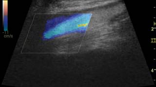 Vascular Ultrasound [upl. by Ruth612]