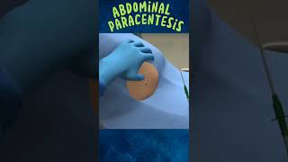 Abdominal Paracentesis 3D Animation Pait Se Pani Nikalna [upl. by Yrtneg247]