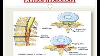 Spinal Stenosis  Medical PowerPoint Presentation [upl. by Assenad]