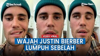 Kondisi Terkini Justin Bierber Usai Umumkan Kelumpuhan Wajah [upl. by Ennaisoj]