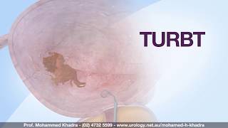 TURBT  TransUrethral Resection of a Bladder Tumour  Professor Mohamed H Khadra [upl. by Nnyleitak]