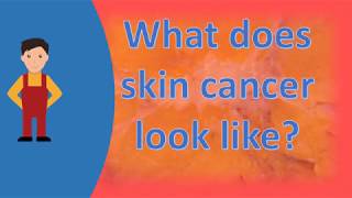 What does skin cancer look like  Best Health FAQS [upl. by Nolram]