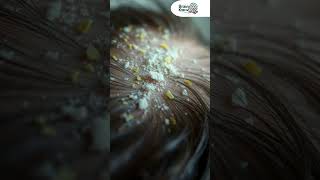 How to Get Rid of Itchy Scalp amp Dandruff – Tips amp Tricks dryscalp itchyscalp dandruff [upl. by Erual]