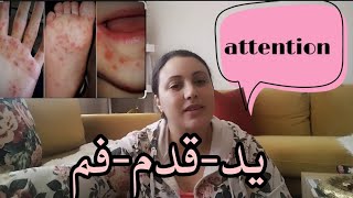 فيروس موجود بقوة حاليا syndrome piedsmainsbouche [upl. by Lorinda]