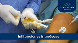 Infiltraciones intraóseas  Dr Oscar Ares [upl. by Anihs]