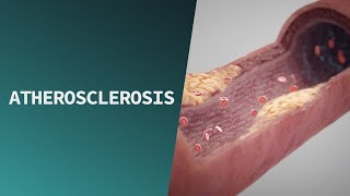 Atherosclerosis  Pathologies [upl. by Corabel]