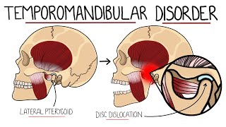 Temporomandibular Joint Disorder Explained TMJ Dysfunction  Includes Treatment amp Anatomy [upl. by Topper]