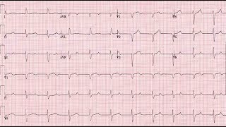 ECG Interpretation Tutorial  ChalkTalk 300 Advanced Level [upl. by Leidgam955]