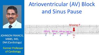 Sinoatrial SA and Atrioventricular AV blocks [upl. by Anirual]