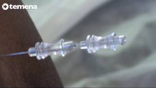 Spinal Anaesthesia with MicroTip® needle Part 22 [upl. by Hurley]