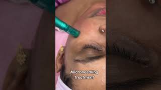 Microneedling needling treatment for skin brighteningskin rejuvenation 😱Skin smile clinic Bhopal [upl. by Thin]