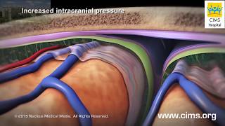 Craniotomy and Craniectomy  CIMS Hospital [upl. by Llerod638]