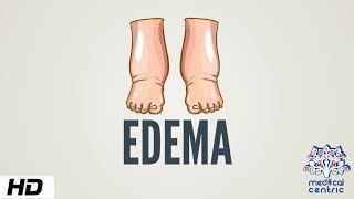 Edema Causes Signs and Symptoms Diagnosis and Treatment [upl. by Hilbert]