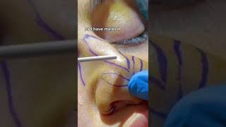 RHINOPLASTY STEPBYSTEP DR TANVEER JANJUA NEW JERSEY [upl. by Bourque533]