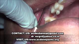 dental abscess aspiration video [upl. by Naesad]