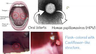 Oral Papilloma  Symptoms causes treatment [upl. by Eatnhoj]