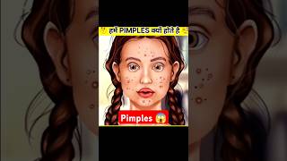 Why do pimples occur on face 🤔  PIMPLES  shorts short [upl. by Rogerson]