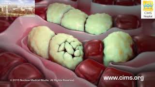 Hepatitis A and B Hindi– CIMS Hospital [upl. by Nawed]